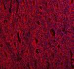 Immunofluorescent staining of IVNS1ABP using anti-IVNS1ABP antibody (red). IVNS1ABP was detected in a paraffin-embedded section of human colon cancer tissue. Heat mediated antigen retrieval was performed in EDTA buffer (pH 8.0, epitope retrieval solution). The tissue section was blocked with 10% goat serum. The tissue section was then incubated with 5 ug/ml rabbit anti-IVNS1ABP antibody overnight at 4oC. Biotin conjugated goat anti-rabbit IgG was used as secondary antibody and incubated for 30 minutes at 37oC. The tissue section was developed using Cy3-conjugated Anti-rabbit IgG Secondary antibody (red). The section was counterstained with DAPI nuclear stain (blue). Visualize using a fluorescence microscope and filter sets appropriate for the label used.