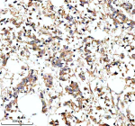Immunohistochemical staining of PARP16 using anti-PARP16 antibody. PARP16 was detected in a paraffin-embedded section of human breast cancer tissue. Heat mediated antigen retrieval was performed in EDTA buffer (pH 8.0, epitope retrieval solution). The tissue section was blocked with 10% goat serum. The tissue section was then incubated with 2 ug/ml rabbit anti-PARP16 antibody overnight at 4oC. Peroxidase Conjugated Goat Anti-rabbit IgG was used as secondary antibody and incubated for 30 minutes at 37oC. The tissue section was developed using an HRP secondary and DAB substrate.