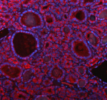 Immunofluorescent staining of PARP16 using anti-PARP16 antibody (red). PARP16 was detected in a paraffin-embedded section of human thyroid cancer tissue. Heat mediated antigen retrieval was performed in EDTA buffer (pH 8.0, epitope retrieval solution). The tissue section was blocked with 10% goat serum. The tissue section was then incubated with 5 ug/ml rabbit anti-PARP16 antibody overnight at 4oC. Cy3 Conjugated Goat Anti-Rabbit IgG was used as secondary antibody at 1:500 dilution and incubated for 30 minutes at 37oC. The section was counterstained with DAPI nuclear stain (blue). Visualize using a fluorescence microscope and filter sets appropriate for the label used.