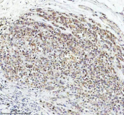 Immunohistochemical staining of STRIP2 using anti-STRIP2 antibody. STRIP2 was detected in a paraffin-embedded section of human breast cancer tissue. Heat mediated antigen retrieval was performed in EDTA buffer (pH 8.0, epitope retrieval solution). The tissue section was blocked with 10% goat serum. The tissue section was then incubated with 2 ug/ml rabbit anti-STRIP2 antibody overnight at 4oC. Peroxidase Conjugated Goat Anti-rabbit IgG was used as secondary antibody and incubated for 30 minutes at 37oC. The tissue section was developed using an HRP secondary and DAB substrate.