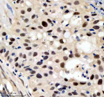 Immunohistochemical staining of SIN3B using anti-SIN3B antibody. SIN3B was detected in a paraffin-embedded section of human bladder cancer tissue. Heat mediated antigen retrieval was performed in EDTA buffer (pH 8.0, epitope retrieval solution). The tissue section was blocked with 10% goat serum. The tissue section was then incubated with 2 ug/ml rabbit anti-SIN3B antibody overnight at 4oC. Peroxidase Conjugated Goat Anti-rabbit IgG was used as secondary antibody and incubated for 30 minutes at 37oC. The tissue section was developed using an HRP secondary and DAB substrate.