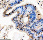 Immunohistochemical staining of SIN3B using anti-SIN3B antibody. SIN3B was detected in a paraffin-embedded section of human colon cancer tissue. Heat mediated antigen retrieval was performed in EDTA buffer (pH 8.0, epitope retrieval solution). The tissue section was blocked with 10% goat serum. The tissue section was then incubated with 2 ug/ml rabbit anti-SIN3B antibody overnight at 4oC. Peroxidase Conjugated Goat Anti-rabbit IgG was used as secondary antibody and incubated for 30 minutes at 37oC. The tissue section was developed using an HRP secondary and DAB substrate.