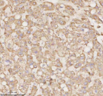 Immunohistochemical staining of MICALL1 using anti-MICALL1 antibody. MICALL1 was detected in a paraffin-embedded section of human liver cancer tissue. Heat mediated antigen retrieval was performed in EDTA buffer (pH 8.0, epitope retrieval solution). The tissue section was blocked with 10% goat serum. The tissue section was then incubated with 2 ug/ml rabbit anti-MICALL1 antibody overnight at 4oC. Peroxidase Conjugated Goat Anti-rabbit IgG was used as secondary antibody and incubated for 30 minutes at 37oC. The tissue section was developed using an HRP secondary and DAB substrate.