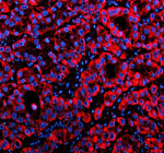 Immunofluorescent staining of MFSD2A using anti-MFSD2A antibody (red). MFSD2A was detected in a paraffin-embedded section of human liver cancer tissue. Heat mediated antigen retrieval was performed in EDTA buffer (pH 8.0, epitope retrieval solution). The tissue section was blocked with 10% goat serum. The tissue section was then incubated with 5 ug/ml rabbit anti-MFSD2A antibody overnight at 4oC. Cy3 Conjugated Goat Anti-Rabbit IgG was used as secondary antibody at 1:500 dilution and incubated for 30 minutes at 37oC. The section was counterstained with DAPI nuclear stain (blue). Visualize using a fluorescence microscope and filter sets appropriate for the label used.