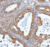 Immunohistochemical staining of NUP62 using anti-NUP62 antibody. NUP62 was detected in a paraffin-embedded section of human ovarian cancer tissue. Heat mediated antigen retrieval was performed in EDTA buffer (pH 8.0, epitope retrieval solution). The tissue section was blocked with 10% goat serum. The tissue section was then incubated with 2 ug/ml rabbit anti-NUP62 antibody overnight at 4oC. Peroxidase Conjugated Goat Anti-rabbit IgG was used as secondary antibody and incubated for 30 minutes at 37oC. The tissue section was developed using an HRP secondary and DAB substrate.