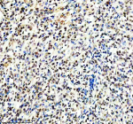 Immunohistochemical staining of TERF2IP using anti-TERF2IP antibody. TERF2IP was detected in a paraffin-embedded section of human lymphoma tissue. Heat mediated antigen retrieval was performed in EDTA buffer (pH 8.0, epitope retrieval solution). The tissue section was blocked with 10% goat serum. The tissue section was then incubated with 2 ug/ml rabbit anti-TERF2IP antibody overnight at 4oC. Peroxidase Conjugated Goat Anti-rabbit IgG was used as secondary antibody and incubated for 30 minutes at 37oC. The tissue section was developed using an HRP secondary and DAB substrate.