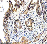 Immunohistochemical staining of RTRAF using anti-RTRAF antibody. RTRAF was detected in a paraffin-embedded section of human colon cancer tissue. Heat mediated antigen retrieval was performed in EDTA buffer (pH 8.0, epitope retrieval solution). The tissue section was blocked with 10% goat serum. The tissue section was then incubated with 2 ug/ml rabbit anti-RTRAF antibody overnight at 4oC. Peroxidase Conjugated Goat Anti-rabbit IgG was used as secondary antibody and incubated for 30 minutes at 37oC. The tissue section was developed using an HRP secondary and DAB substrate.