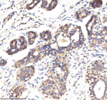 Immunohistochemical staining of MARVELD2 using anti-MARVELD2 antibody. MARVELD2 was detected in a paraffin-embedded section of human breast cancer tissue. Heat mediated antigen retrieval was performed in EDTA buffer (pH 8.0, epitope retrieval solution). The tissue section was blocked with 10% goat serum. The tissue section was then incubated with 2 ug/ml rabbit anti-MARVELD2 antibody overnight at 4oC. Peroxidase Conjugated Goat Anti-rabbit IgG was used as secondary antibody and incubated for 30 minutes at 37oC. The tissue section was developed using an HRP secondary and DAB substrate.
