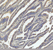 Immunohistochemical staining of SOS1 using anti-SOS1 antibody. SOS1 was detected in a paraffin-embedded section of human colon cancer tissue. Heat mediated antigen retrieval was performed in EDTA buffer (pH 8.0, epitope retrieval solution). The tissue section was blocked with 10% goat serum. The tissue section was then incubated with 2 ug/ml rabbit anti-SOS1 antibody overnight at 4oC. Peroxidase Conjugated Goat Anti-rabbit IgG was used as secondary antibody and incubated for 30 minutes at 37oC. The tissue section was developed using an HRP secondary and DAB substrate.
