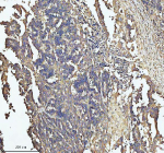 Immunohistochemical staining of SOS1 using anti-SOS1 antibody. SOS1 was detected in a paraffin-embedded section of human colon cancer tissue. Heat mediated antigen retrieval was performed in EDTA buffer (pH 8.0, epitope retrieval solution). The tissue section was blocked with 10% goat serum. The tissue section was then incubated with 2 ug/ml rabbit anti-SOS1 antibody overnight at 4oC. Peroxidase Conjugated Goat Anti-rabbit IgG was used as secondary antibody and incubated for 30 minutes at 37oC. The tissue section was developed using an HRP secondary and DAB substrate.