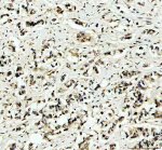 ITPKC Antibody by IHC in human breast cancer with fibrous stroma. Immunohistochemistry of FFPE human breast cancer tissue using ITPKC Antibody at 2 ug/ml. Irregularly distributed cells and small cellular clusters are visible within a fibrous stromal background. Brown immunoreactivity ranges from weak cytoplasmic staining to stronger labeling in scattered cells, while hematoxylin counterstains nuclei blue-purple. The heterogeneous distribution highlights ITPKC expression within the cellular components of the tissue. Heat-mediated antigen retrieval was performed using EDTA buffer at pH 8.0, followed by overnight primary antibody incubation at 4oC. This Inositol Trisphosphate 3-Kinase C Polyclonal Antibody demonstrates tissue immunoreactivity.