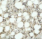 ITPKC Antibody by IHC in human breast cancer with adipose tissue. Immunohistochemistry of FFPE human breast cancer tissue using ITPKC Antibody at 2 ug/ml. The section contains numerous adipocytes surrounded by cellular tissue exhibiting light-to-moderate brown immunoreactivity, with stronger staining in scattered cells. Adipocyte lipid vacuoles remain unstained, while hematoxylin highlights blue-purple nuclei. Staining is predominantly extranuclear, although precise localization is difficult to establish. Heat-mediated antigen retrieval was performed in EDTA buffer at pH 8.0, followed by overnight primary antibody incubation at 4oC. This Inositol Trisphosphate 3-Kinase C Polyclonal Antibody demonstrates immunoreactivity within the cellular component of the tissue.