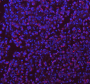 Immunohistochemical staining of SASS6 using anti-SASS6 antibody (red). SASS6 was detected in a paraffin-embedded section of human appendiceal carcinoid tissue. Heat mediated antigen retrieval was performed in EDTA buffer (pH 8.0, epitope retrieval solution). The tissue section was blocked with 10% goat serum. The tissue section was then incubated with 2 ug/ml rabbit anti-SASS6 antibody overnight at 4oC. Peroxidase Conjugated Goat Anti-rabbit IgG was used as secondary antibody and incubated for 30 minutes at 37oC. The tissue section was developed using an HRP secondary and DAB substrate.