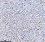 Immunohistochemical staining of SASS6 using anti-SASS6 antibody. SASS6 was detected in a paraffin-embedded section of human testicular seminoma tissue. Heat mediated antigen retrieval was performed in EDTA buffer (pH 8.0, epitope retrieval solution). The tissue section was blocked with 10% goat serum. The tissue section was then incubated with 2 ug/ml rabbit anti-SASS6 antibody overnight at 4oC. Peroxidase Conjugated Goat Anti-rabbit IgG was used as secondary antibody and incubated for 30 minutes at 37oC. The tissue section was developed using an HRP secondary and DAB substrate.