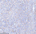 Immunohistochemical staining of SASS6 using anti-SASS6 antibody. SASS6 was detected in a paraffin-embedded section of human cervix squamous cell carcinoma tissue. Heat mediated antigen retrieval was performed in EDTA buffer (pH 8.0, epitope retrieval solution). The tissue section was blocked with 10% goat serum. The tissue section was then incubated with 2 ug/ml rabbit anti-SASS6 antibody overnight at 4oC. Peroxidase Conjugated Goat Anti-rabbit IgG was used as secondary antibody and incubated for 30 minutes at 37oC. The tissue section was developed using an HRP secondary and DAB substrate.