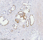 Immunohistochemical staining of SASS6 using anti-SASS6 antibody. SASS6 was detected in a paraffin-embedded section of human rectum adenocarcinoma tissue. Heat mediated antigen retrieval was performed in EDTA buffer (pH 8.0, epitope retrieval solution). The tissue section was blocked with 10% goat serum. The tissue section was then incubated with 2 ug/ml rabbit anti-SASS6 antibody overnight at 4oC. Peroxidase Conjugated Goat Anti-rabbit IgG was used as secondary antibody and incubated for 30 minutes at 37oC. The tissue section was developed using an HRP secondary and DAB substrate.