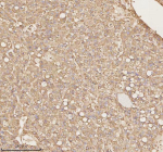 Immunohistochemical staining of PTCD1 using anti-PTCD1 antibody. PTCD1 was detected in a paraffin-embedded section of human liver cancer tissue. Heat mediated antigen retrieval was performed in EDTA buffer (pH 8.0, epitope retrieval solution). The tissue section was blocked with 10% goat serum. The tissue section was then incubated with 2 ug/ml rabbit anti-PTCD1 antibody overnight at 4oC. Peroxidase Conjugated Goat Anti-rabbit IgG was used as secondary antibody and incubated for 30 minutes at 37oC. The tissue section was developed using an HRP secondary and DAB substrate.
