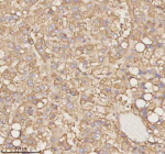 Immunohistochemical staining of PTCD1 using anti-PTCD1 antibody. PTCD1 was detected in a paraffin-embedded section of human liver cancer tissue. Heat mediated antigen retrieval was performed in EDTA buffer (pH 8.0, epitope retrieval solution). The tissue section was blocked with 10% goat serum. The tissue section was then incubated with 2 ug/ml rabbit anti-PTCD1 antibody overnight at 4oC. Peroxidase Conjugated Goat Anti-rabbit IgG was used as secondary antibody and incubated for 30 minutes at 37oC. The tissue section was developed using an HRP secondary and DAB substrate.