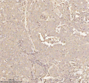 Immunohistochemical staining of PTCD1 using anti-PTCD1 antibody. PTCD1 was detected in a paraffin-embedded section of human thyroid papillary carcinoma tissue. Heat mediated antigen retrieval was performed in EDTA buffer (pH 8.0, epitope retrieval solution). The tissue section was blocked with 10% goat serum. The tissue section was then incubated with 2 ug/ml rabbit anti-PTCD1 antibody overnight at 4oC. Peroxidase Conjugated Goat Anti-rabbit IgG was used as secondary antibody and incubated for 30 minutes at 37oC. The tissue section was developed using an HRP secondary and DAB substrate.