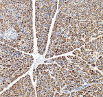 Immunohistochemical staining of OGFOD3 using anti-OGFOD3 antibody. OGFOD3 was detected in a paraffin-embedded section of human liver cancer tissue. Heat mediated antigen retrieval was performed in EDTA buffer (pH 8.0, epitope retrieval solution). The tissue section was blocked with 10% goat serum. The tissue section was then incubated with 2 ug/ml rabbit anti-OGFOD3 antibody overnight at 4oC. Peroxidase Conjugated Goat Anti-rabbit IgG was used as secondary antibody and incubated for 30 minutes at 37oC. The tissue section was developed using an HRP secondary and DAB substrate.
