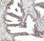 Immunohistochemical staining of NDUFA1 using anti-NDUFA1 antibody. NDUFA1 was detected in a paraffin-embedded section of human prostate cancer tissue. Heat mediated antigen retrieval was performed in EDTA buffer (pH 8.0, epitope retrieval solution). The tissue section was blocked with 10% goat serum. The tissue section was then incubated with 2 ug/ml rabbit anti-NDUFA1 antibody overnight at 4oC. Peroxidase Conjugated Goat Anti-rabbit IgG was used as secondary antibody and incubated for 30 minutes at 37oC. The tissue section was developed using an HRP secondary and DAB substrate.
