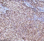 Immunohistochemical staining of RBM42 using anti-RBM42 antibody. RBM42 was detected in a paraffin-embedded section of human cervix squamous cell carcinoma tissue. Heat mediated antigen retrieval was performed in EDTA buffer (pH 8.0, epitope retrieval solution). The tissue section was blocked with 10% goat serum. The tissue section was then incubated with 2 ug/ml rabbit anti-RBM42 antibody overnight at 4oC. Peroxidase Conjugated Goat Anti-rabbit IgG was used as secondary antibody and incubated for 30 minutes at 37oC. The tissue section was developed using an HRP secondary and DAB substrate.