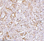 Immunohistochemical staining of RBM42 using anti-RBM42 antibody. RBM42 was detected in a paraffin-embedded section of human prostate adenocarcinoma tissue. Heat mediated antigen retrieval was performed in EDTA buffer (pH 8.0, epitope retrieval solution). The tissue section was blocked with 10% goat serum. The tissue section was then incubated with 2 ug/ml rabbit anti-RBM42 antibody overnight at 4oC. Peroxidase Conjugated Goat Anti-rabbit IgG was used as secondary antibody and incubated for 30 minutes at 37oC. The tissue section was developed using an HRP secondary and DAB substrate.