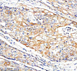 Immunohistochemical staining of FUNDC1 using anti-FUNDC1 antibody. FUNDC1 was detected in a paraffin-embedded section of human cervical cancer tissue. Heat mediated antigen retrieval was performed in EDTA buffer (pH 8.0, epitope retrieval solution). The tissue section was blocked with 10% goat serum. The tissue section was then incubated with 2 ug/ml rabbit anti-FUNDC1 antibody overnight at 4oC. Peroxidase Conjugated Goat Anti-rabbit IgG was used as secondary antibody and incubated for 30 minutes at 37oC. The tissue section was developed using an HRP secondary and DAB substrate.