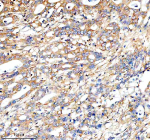 Immunohistochemical staining of FUNDC1 using anti-FUNDC1 antibody. FUNDC1 was detected in a paraffin-embedded section of human pancreas cancer tissue. Heat mediated antigen retrieval was performed in EDTA buffer (pH 8.0, epitope retrieval solution). The tissue section was blocked with 10% goat serum. The tissue section was then incubated with 2 ug/ml rabbit anti-FUNDC1 antibody overnight at 4oC. Peroxidase Conjugated Goat Anti-rabbit IgG was used as secondary antibody and incubated for 30 minutes at 37oC. The tissue section was developed using an HRP secondary and DAB substrate.