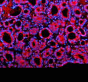 Immunofluorescent staining of SHE using anti-SHE antibody (red). SHE was detected in a paraffin-embedded section of human thyroid cancer tissue. Heat mediated antigen retrieval was performed in EDTA buffer (pH 8.0, epitope retrieval solution). The tissue section was blocked with 10% goat serum. The tissue section was then incubated with 5 ug/ml rabbit anti-SHE antibody overnight at 4oC. Cy3 Conjugated Goat Anti-Rabbit IgG was used as secondary antibody at 1:500 dilution and incubated for 30 minutes at 37oC. The section was counterstained with DAPI nuclear stain (blue). Visualize using a fluorescence microscope and filter sets appropriate for the label used.
