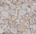 Immunohistochemical staining of SHE using anti-SHE antibody. SHE was detected in a paraffin-embedded section of human thyroid cancer tissue. Heat mediated antigen retrieval was performed in EDTA buffer (pH 8.0, epitope retrieval solution). The tissue section was blocked with 10% goat serum. The tissue section was then incubated with 2 ug/ml rabbit anti-SHE antibody overnight at 4oC. Peroxidase Conjugated Goat Anti-rabbit IgG was used as secondary antibody and incubated for 30 minutes at 37oC. The tissue section was developed using an HRP secondary and DAB substrate.