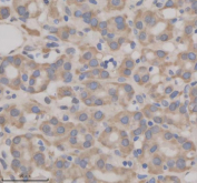 Immunohistochemical staining of SHE using anti-SHE antibody. SHE was detected in a paraffin-embedded section of human thyroid cancer tissue. Heat mediated antigen retrieval was performed in EDTA buffer (pH 8.0, epitope retrieval solution). The tissue section was blocked with 10% goat serum. The tissue section was then incubated with 2 ug/ml rabbit anti-SHE antibody overnight at 4oC. Peroxidase Conjugated Goat Anti-rabbit IgG was used as secondary antibody and incubated for 30 minutes at 37oC. The tissue section was developed using an HRP secondary and DAB substrate.