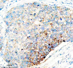 Immunohistochemical staining of NDUFB11 using anti-NDUFB11 antibody. NDUFB11 was detected in a paraffin-embedded section of human lung cancer tissue. Heat mediated antigen retrieval was performed in EDTA buffer (pH 8.0, epitope retrieval solution). The tissue section was blocked with 10% goat serum. The tissue section was then incubated with 2 ug/ml rabbit anti-NDUFB11 antibody overnight at 4oC. Peroxidase Conjugated Goat Anti-rabbit IgG was used as secondary antibody and incubated for 30 minutes at 37oC. The tissue section was developed using an HRP secondary and DAB substrate.