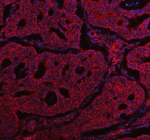 Immunofluorescent staining of ABCG5 using anti-ABCG5 antibody (red). ABCG5 was detected in a paraffin-embedded section of human colon cancer tissue. Heat mediated antigen retrieval was performed in EDTA buffer (pH 8.0, epitope retrieval solution). The tissue section was blocked with 10% goat serum. The tissue section was then incubated with 5 ug/ml rabbit anti-ABCG5 antibody overnight at 4oC. Cy3 Conjugated Goat Anti-Rabbit IgG was used as secondary antibody at 1:500 dilution and incubated for 30 minutes at 37oC. The section was counterstained with DAPI nuclear stain (blue). Visualize using a fluorescence microscope and filter sets appropriate for the label used.