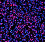 Immunofluorescent staining of NUPR1 using anti-NUPR1 antibody (red). NUPR1 was detected in a paraffin-embedded section of human bladder cancer tissue. Heat mediated antigen retrieval was performed in EDTA buffer (pH 8.0, epitope retrieval solution). The tissue section was blocked with 10% goat serum. The tissue section was then incubated with 5 ug/ml rabbit anti-NUPR1 antibody overnight at 4oC. Cy3 Conjugated Goat Anti-Rabbit IgG was used as secondary antibody at 1:500 dilution and incubated for 30 minutes at 37oC. The section was counterstained with DAPI nuclear stain (blue). Visualize using a fluorescence microscope and filter sets appropriate for the label used.