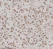 Immunohistochemical staining of NUPR1 using anti-NUPR1 antibody. NUPR1 was detected in a paraffin-embedded section of human bladder cancer tissue. Heat mediated antigen retrieval was performed in EDTA buffer (pH 8.0, epitope retrieval solution). The tissue section was blocked with 10% goat serum. The tissue section was then incubated with 2 ug/ml rabbit anti-NUPR1 antibody overnight at 4oC. Peroxidase Conjugated Goat Anti-rabbit IgG was used as secondary antibody and incubated for 30 minutes at 37oC. The tissue section was developed using an HRP secondary and DAB substrate.
