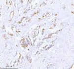 Immunohistochemical staining of PCYOX1 using anti-PCYOX1 antibody. PCYOX1 was detected in a paraffin-embedded section of human breast cancer tissue. Heat mediated antigen retrieval was performed in EDTA buffer (pH 8.0, epitope retrieval solution). The tissue section was blocked with 10% goat serum. The tissue section was then incubated with 2 ug/ml rabbit anti-PCYOX1 antibody overnight at 4oC. Peroxidase Conjugated Goat Anti-rabbit IgG was used as secondary antibody and incubated for 30 minutes at 37oC. The tissue section was developed using an HRP secondary and DAB substrate.