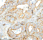 Immunohistochemical staining of SERPING1/C1 using anti-C1 Inhibitor (C1-INH) antibody. SERPING1/C1 was detected in a paraffin-embedded section of human ovarian cancer tissue. Heat mediated antigen retrieval was performed in EDTA buffer (pH 8.0, epitope retrieval solution). The tissue section was blocked with 10% goat serum. The tissue section was then incubated with 1:100 rabbit anti-C1 Inhibitor (C1-INH) antibody overnight at 4oC. Peroxidase Conjugated Goat Anti-rabbit IgG was used as secondary antibody and incubated for 30 minutes at 37oC. The tissue section was developed using an HRP secondary and DAB substrate.