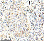 Immunohistochemical staining of SERPING1/C1 using anti-C1 Inhibitor (C1-INH) antibody. SERPING1/C1 was detected in a paraffin-embedded section of human lung cancer tissue. Heat mediated antigen retrieval was performed in EDTA buffer (pH 8.0, epitope retrieval solution). The tissue section was blocked with 10% goat serum. The tissue section was then incubated with 1:100 rabbit anti-C1 Inhibitor (C1-INH) antibody overnight at 4oC. Peroxidase Conjugated Goat Anti-rabbit IgG was used as secondary antibody and incubated for 30 minutes at 37oC. The tissue section was developed using an HRP secondary and DAB substrate.