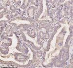 Immunohistochemical staining of MEST using anti-MEST antibody. MEST was detected in a paraffin-embedded section of human thyroid papillary carcinoma tissue. Heat mediated antigen retrieval was performed in EDTA buffer (pH 8.0, epitope retrieval solution). The tissue section was blocked with 10% goat serum. The tissue section was then incubated with 2 ug/ml rabbit anti-MEST antibody overnight at 4oC. Peroxidase Conjugated Goat Anti-rabbit IgG was used as secondary antibody and incubated for 30 minutes at 37oC. The tissue section was developed using an HRP secondary and DAB substrate.