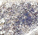 STK4 Antibody by IHC in human lymph tissue. Immunohistochemistry of FFPE human lymph tissue using STK4 Antibody at 2 ug/ml. Brown immunoreactivity is distributed throughout the lymphoid tissue, with variable staining intensity and predominantly cytoplasmic localization. Hematoxylin counterstaining highlights numerous blue-purple nuclei. Heat-mediated antigen retrieval was performed using EDTA buffer at pH 8.0, followed by overnight primary antibody incubation at 4oC. This Mammalian STE20-like Kinase 1 Polyclonal Antibody demonstrates immunoreactivity in human lymphoid tissue.