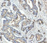 GPRC5A Antibody Human Colon Cancer IHC. Immunohistochemistry analysis of FFPE human colon cancer tissue using GPRC5A Antibody. Heat induced antigen retrieval was performed in pH 8.0 EDTA buffer prior to overnight incubation with primary antibody (2 ug/mL) at 4Â°C. Peroxidase-conjugated goat anti-rabbit IgG and DAB chromogen were used for visualization. Predominantly membranous staining is observed in malignant epithelial cells, consistent with the localization of GPRC5A as a retinoic acid-inducible orphan G protein-coupled receptor. These results support the use of GPRC5A Antibody / Retinoic Acid Inducible GPCR Antibody for studying GPRC5A expression, epithelial GPCR biology and cancer-associated signaling.