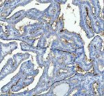 GPRC5A Antibody Human Thyroid Cancer IHC. Immunohistochemistry analysis of FFPE human thyroid cancer tissue using GPRC5A Antibody. Heat induced antigen retrieval was performed in pH 8.0 EDTA buffer prior to overnight incubation with primary antibody (2 ug/mL) at 4Â°C. Peroxidase-conjugated goat anti-rabbit IgG and DAB chromogen were used for visualization. Predominantly membranous staining is observed in malignant epithelial cells, consistent with the localization of GPRC5A as a retinoic acid-inducible orphan G protein-coupled receptor expressed in epithelial tissues. These results support the use of GPRC5A Antibody / Retinoic Acid Inducible GPCR Antibody for studying GPRC5A expression, epithelial GPCR biology and cancer-associated signaling.