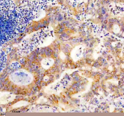 Immunohistochemical staining using SLC25A12 antibody on paraffin-embedded human colon cancer tissue sections. Heat-induced epitope retrieval was performed using EDTA buffer (pH 8.0) prior to antibody incubation. Sections were blocked with 10% goat serum and incubated with SLC25A12 antibody overnight at 4C. Detection was carried out using an HRP-based secondary antibody with DAB as the chromogen. Staining shows cytoplasmic immunoreactivity in tumor cells. Nuclei were counterstained with hematoxylin.