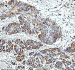 Immunohistochemical staining of GLUD1 using anti-GLUD1 antibody. GLUD1 was detected in a paraffin-embedded section of human esophageal cancer tissue. Heat mediated antigen retrieval was performed in EDTA buffer (pH 8.0, epitope retrieval solution). The tissue section was blocked with 10% goat serum. The tissue section was then incubated with 2 ug/ml rabbit anti-GLUD1 antibody overnight at 4oC. Peroxidase Conjugated Goat Anti-rabbit IgG was used as secondary antibody and incubated for 30 minutes at 37oC. The tissue section was developed using an HRP secondary and DAB substrate.