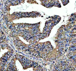Immunohistochemical staining of ADAM12 using anti-ADAM12 antibody. ADAM12 was detected in a paraffin-embedded section of human endometrial cancer tissue. Heat mediated antigen retrieval was performed in EDTA buffer (pH 8.0, epitope retrieval solution). The tissue section was blocked with 10% goat serum. The tissue section was then incubated with 2 ug/ml rabbit anti-ADAM12 antibody overnight at 4oC. Peroxidase Conjugated Goat Anti-rabbit IgG was used as secondary antibody and incubated for 30 minutes at 37oC. The tissue section was developed using an HRP secondary and DAB substrate.