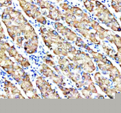 Immunohistochemical staining of MSTO1 using anti-MSTO1 antibody. MSTO1 was detected in a paraffin-embedded section of human liver cancer tissue. Heat mediated antigen retrieval was performed in EDTA buffer (pH 8.0, epitope retrieval solution). The tissue section was blocked with 10% goat serum. The tissue section was then incubated with 2 ug/ml rabbit anti-MSTO1 antibody overnight at 4oC. Peroxidase Conjugated Goat Anti-rabbit IgG was used as secondary antibody and incubated for 30 minutes at 37oC. The tissue section was developed using an HRP secondary and DAB substrate.