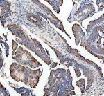 STAM2 Antibody Human Colon Cancer IHC. Immunohistochemical staining of FFPE human colon cancer tissue using STAM2 Antibody / Signal Transducing Adaptor Molecule 2 Antibody. Heat-induced epitope retrieval was performed in pH 8.0 EDTA buffer before incubation with rabbit anti-STAM2 antibody at 2 ug/ml. An HRP-conjugated goat anti-rabbit secondary antibody with DAB chromogen was used for visualization. STAM2 immunoreactivity is predominantly cytoplasmic with moderate to strong staining in malignant epithelial cells, consistent with the protein's role in endosomal sorting and intracellular vesicle trafficking. This STAM2 Antibody, also called Signal Transducing Adaptor Molecule 2 Antibody, is suitable for investigating STAM2 expression in human tissues.