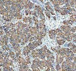 STAM2 Antibody Human Liver Cancer IHC. Immunohistochemical staining of FFPE human liver cancer tissue using STAM2 Antibody / Signal Transducing Adaptor Molecule 2 Antibody. Heat-induced epitope retrieval was performed in pH 8.0 EDTA buffer before incubation with rabbit anti-STAM2 antibody at 2 ug/ml. An HRP-conjugated goat anti-rabbit secondary antibody with DAB chromogen was used for visualization. STAM2 shows moderate to strong predominantly cytoplasmic staining in tumor cells, consistent with its role in endosomal sorting and intracellular vesicle trafficking. This STAM2 Antibody, also called Signal Transducing Adaptor Molecule 2 Antibody, is suitable for investigating STAM2 expression in human tissues.