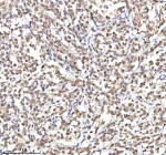 Immunohistochemical staining of RSRC2 using anti-RSRC2 antibody. RSRC2 was detected in a paraffin-embedded section of diffuse large B-cell lymphoma of human intestine tissue. Heat mediated antigen retrieval was performed in EDTA buffer (pH 8.0, epitope retrieval solution). The tissue section was blocked with 10% goat serum. The tissue section was then incubated with 2 ug/ml rabbit anti-RSRC2 antibody overnight at 4oC. Peroxidase Conjugated Goat Anti-rabbit IgG was used as secondary antibody and incubated for 30 minutes at 37oC. The tissue section was developed using an HRP secondary and DAB substrate.